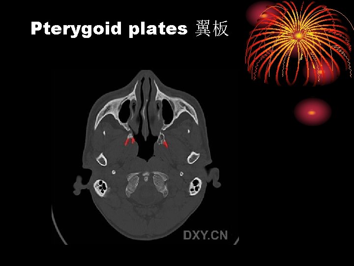 Pterygoid plates 翼板 