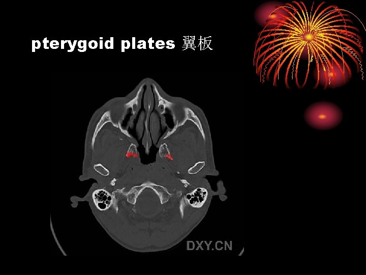 pterygoid plates 翼板 