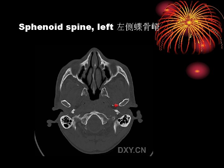 Sphenoid spine, left 左侧蝶骨嵴 