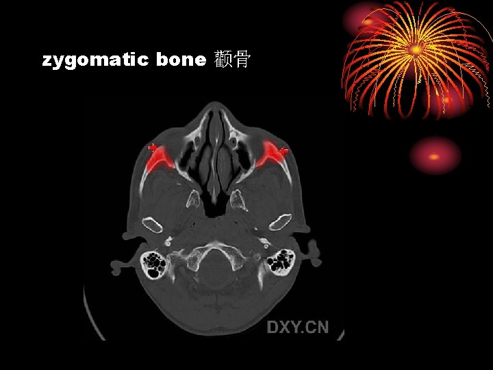zygomatic bone 颧骨 
