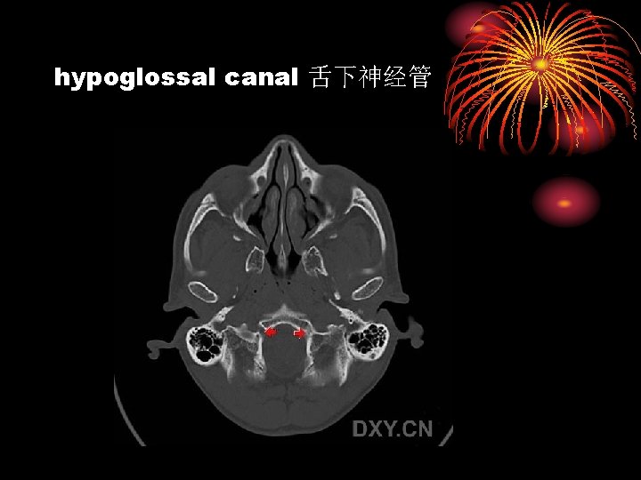 hypoglossal canal 舌下神经管 