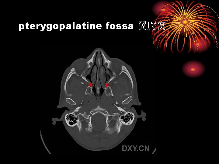 pterygopalatine fossa 翼腭窝 