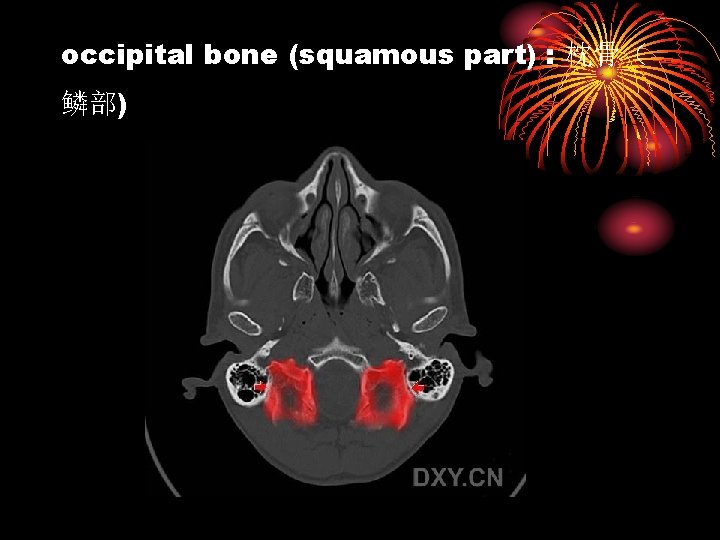 occipital bone (squamous part) : 枕骨（ 鳞部) 