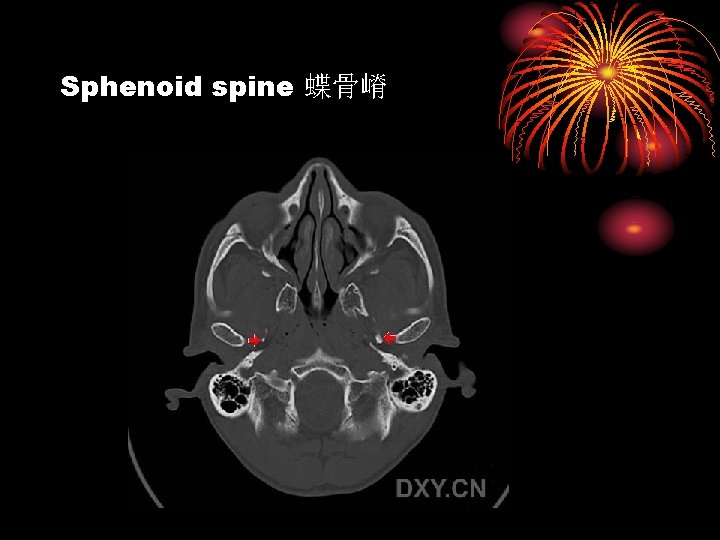 Sphenoid spine 蝶骨嵴 