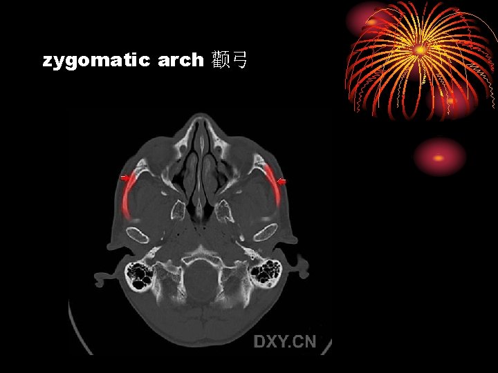 zygomatic arch 颧弓 