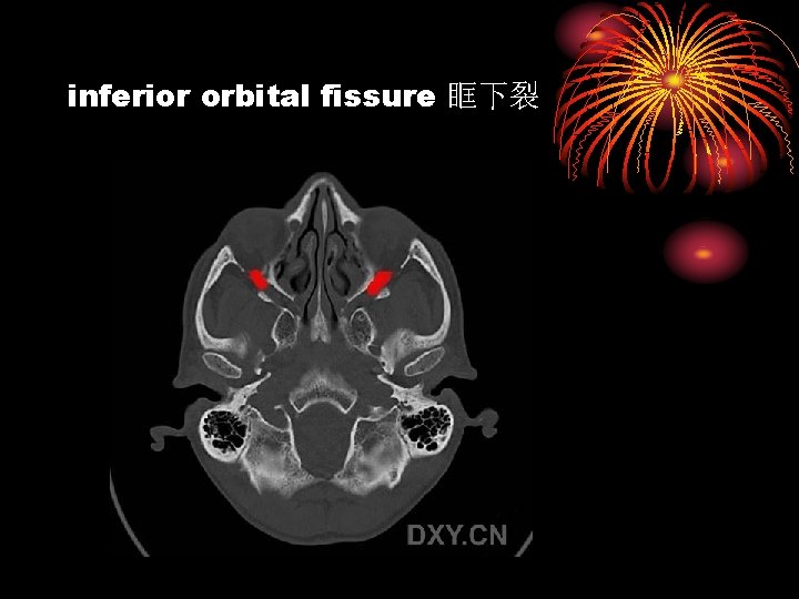 inferior orbital fissure 眶下裂 