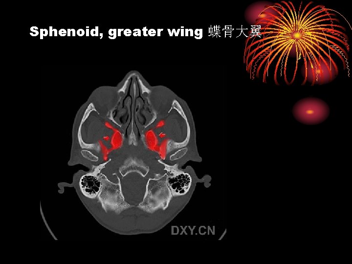 Sphenoid, greater wing 蝶骨大翼 