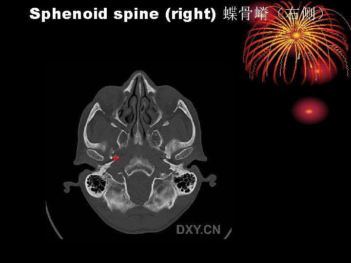 Sphenoid spine (right) 蝶骨嵴（右侧） 
