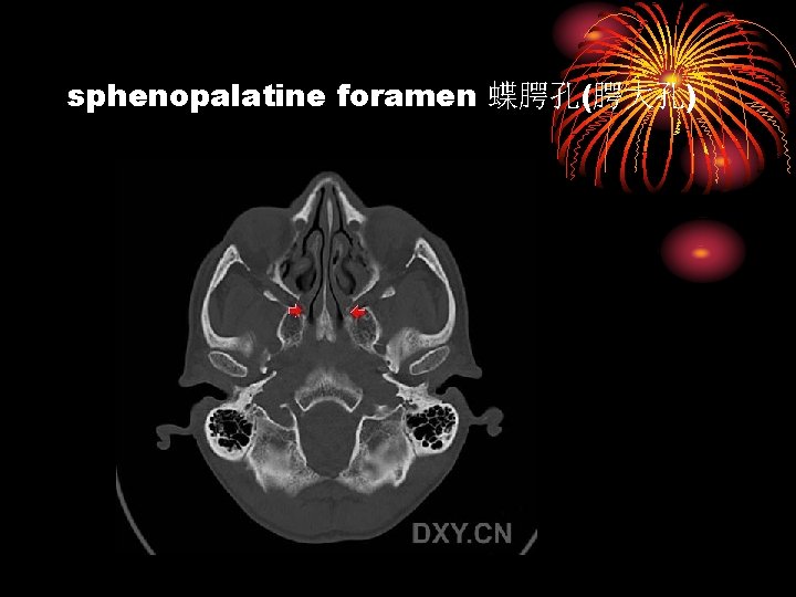 sphenopalatine foramen 蝶腭孔(腭大孔) 