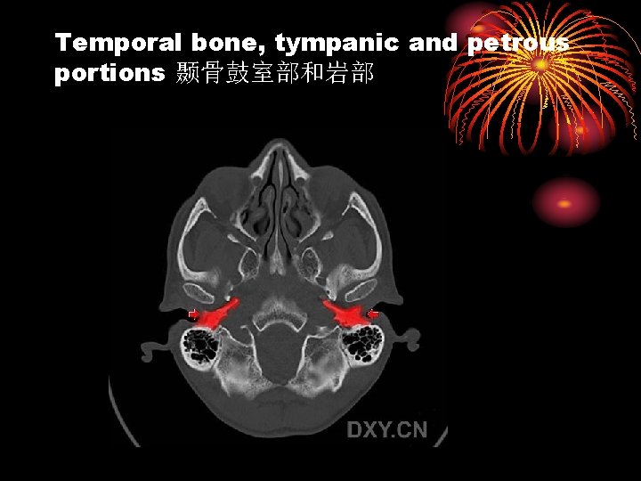 Temporal bone, tympanic and petrous portions 颞骨鼓室部和岩部 