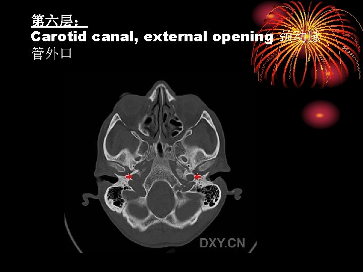 第六层： Carotid canal, external opening 颈动脉 管外口 