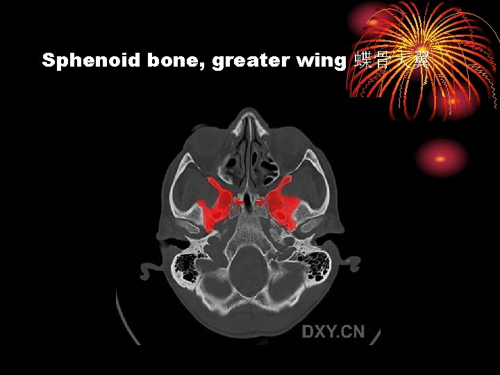 Sphenoid bone, greater wing 蝶骨大翼 