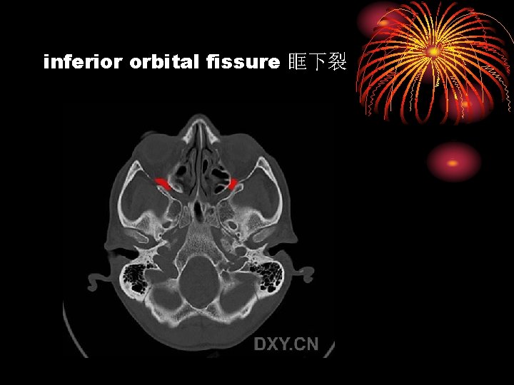 inferior orbital fissure 眶下裂 