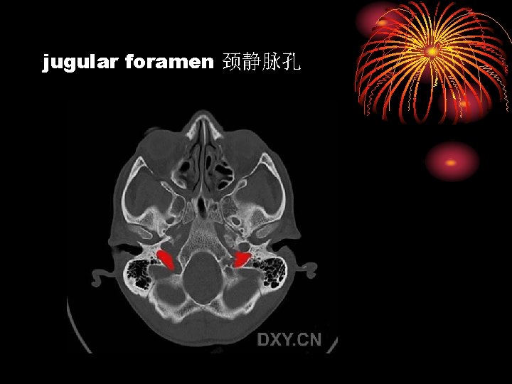 jugular foramen 颈静脉孔 