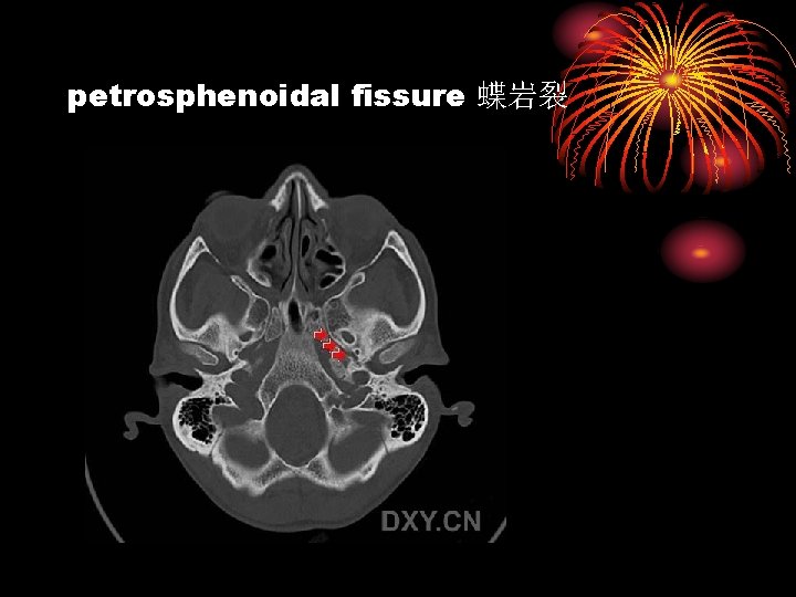 petrosphenoidal fissure 蝶岩裂 