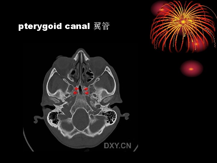 pterygoid canal 翼管 