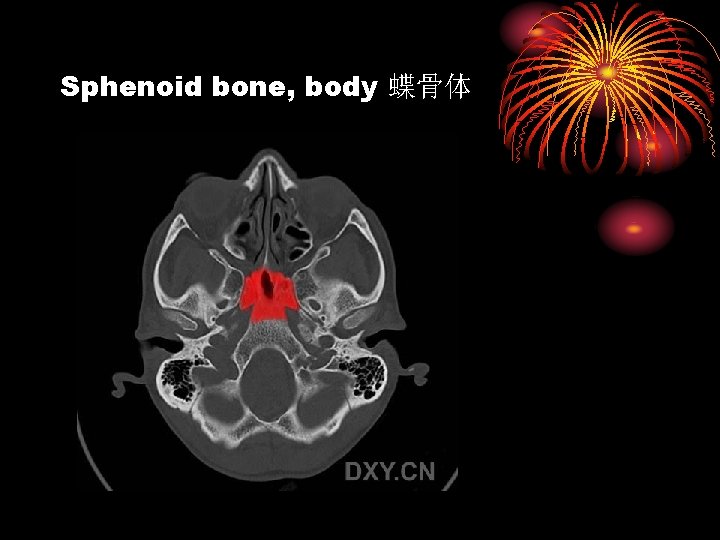 Sphenoid bone, body 蝶骨体 