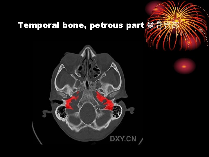 Temporal bone, petrous part 颞骨岩部 