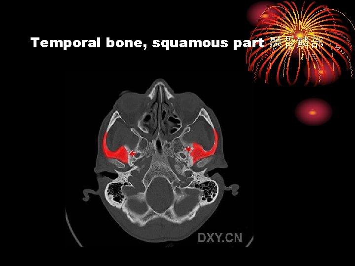Temporal bone, squamous part 颞骨鳞部 