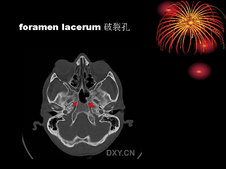 foramen lacerum 破裂孔 