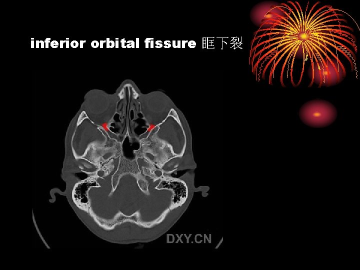 inferior orbital fissure 眶下裂 