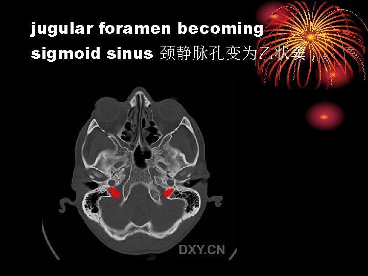 jugular foramen becoming sigmoid sinus 颈静脉孔变为乙状窦 
