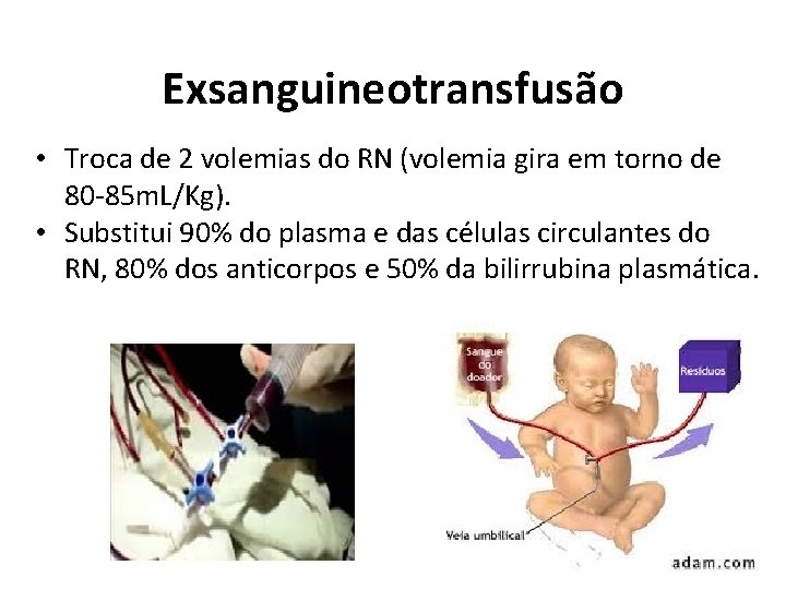 Exsanguineotransfusão • Troca de 2 volemias do RN (volemia gira em torno de 80