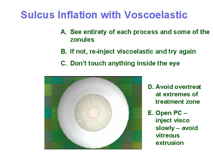 Sulcus Inflation with Voscoelastic A. See entirety of each process and some of the