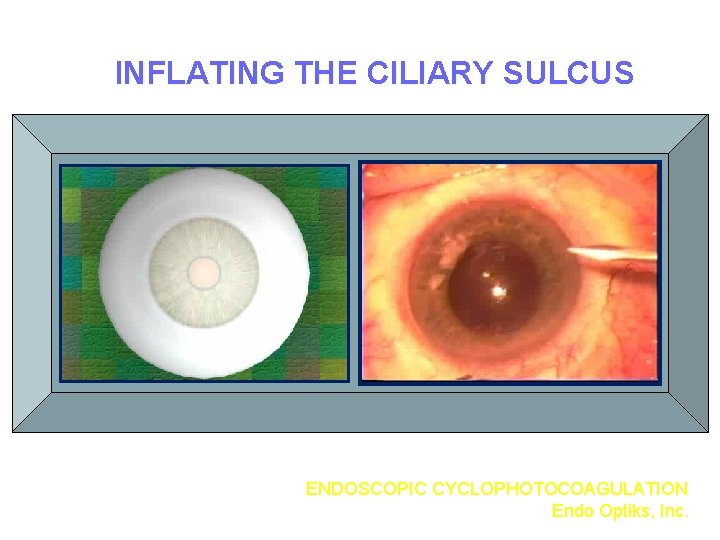 INFLATING THE CILIARY SULCUS ENDOSCOPIC CYCLOPHOTOCOAGULATION Endo Optiks, Inc. 