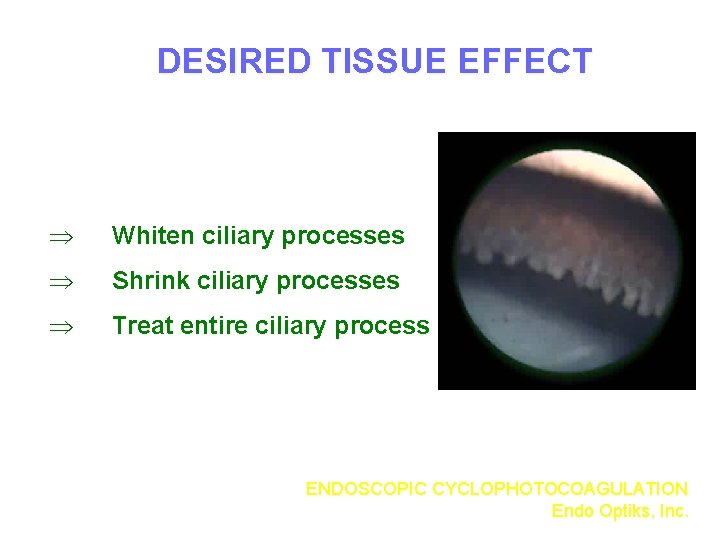 DESIRED TISSUE EFFECT Þ Whiten ciliary processes Þ Shrink ciliary processes Þ Treat entire