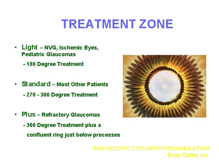 TREATMENT ZONE • Light – NVG, Ischemic Eyes, Pediatric Glaucomas - 180 Degree Treatment