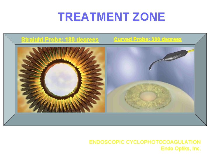 TREATMENT ZONE Straight Probe: 180 degrees Curved Probe: 300 degrees ENDOSCOPIC CYCLOPHOTOCOAGULATION Endo Optiks,