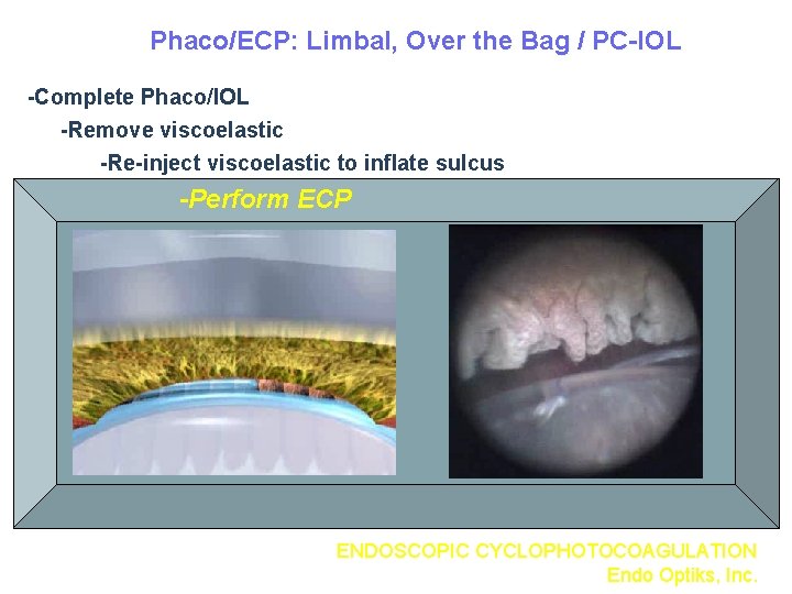 Phaco/ECP: Limbal, Over the Bag / PC-IOL -Complete Phaco/IOL -Remove viscoelastic -Re-inject viscoelastic to