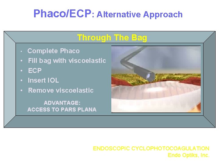 Phaco/ECP: Alternative Approach Through The Bag • Complete Phaco • • Fill bag with