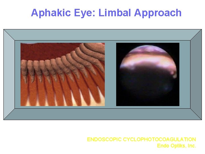 Aphakic Eye: Limbal Approach ENDOSCOPIC CYCLOPHOTOCOAGULATION Endo Optiks, Inc. 