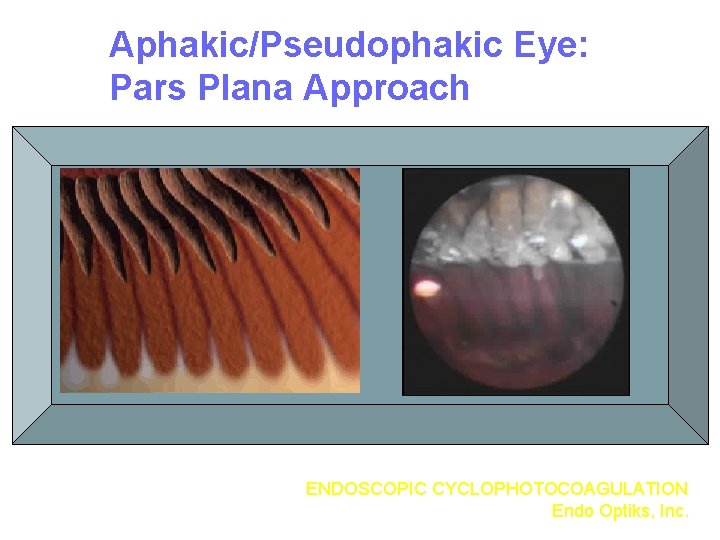 Aphakic/Pseudophakic Eye: Pars Plana Approach ENDOSCOPIC CYCLOPHOTOCOAGULATION Endo Optiks, Inc. 