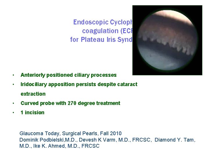 Endoscopic Cyclophotocoagulation (ECP) for Plateau Iris Syndrome • Anteriorly positioned ciliary processes • Iridociliary
