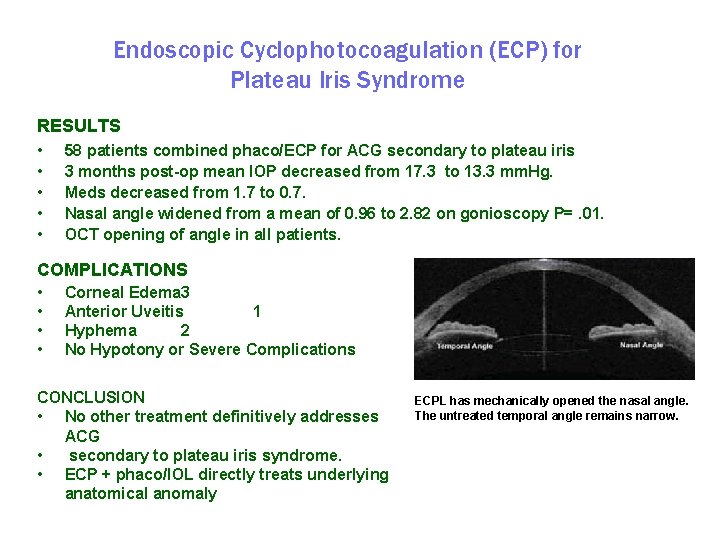 Endoscopic Cyclophotocoagulation (ECP) for Plateau Iris Syndrome RESULTS • • • 58 patients combined