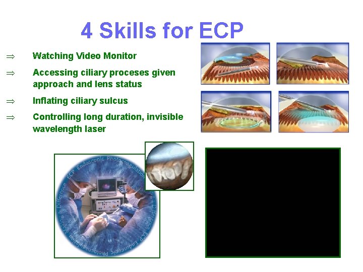 4 Skills for ECP Þ Watching Video Monitor Þ Accessing ciliary proceses given approach