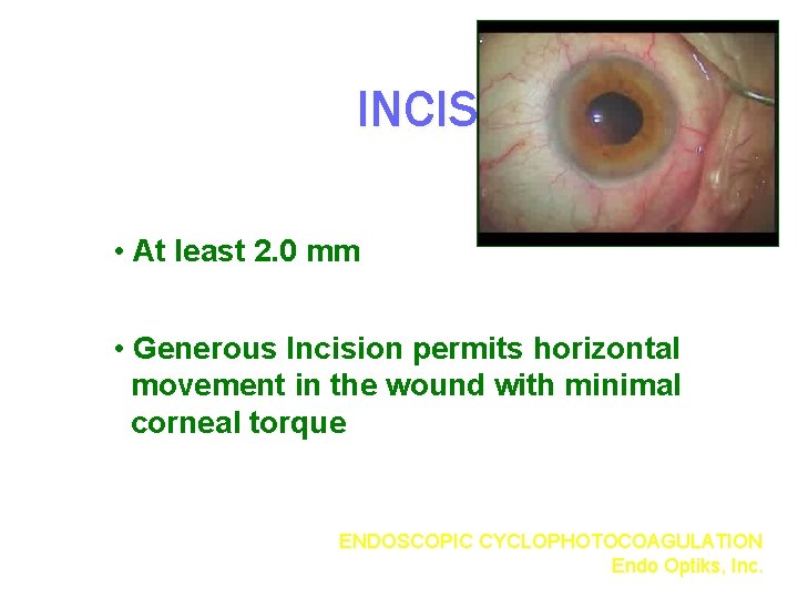 INCISION • At least 2. 0 mm • Generous Incision permits horizontal movement in