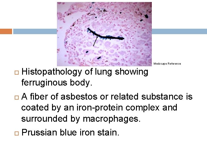 Medscape Reference Histopathology of lung showing ferruginous body. A fiber of asbestos or related