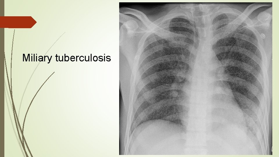 Miliary tuberculosis 