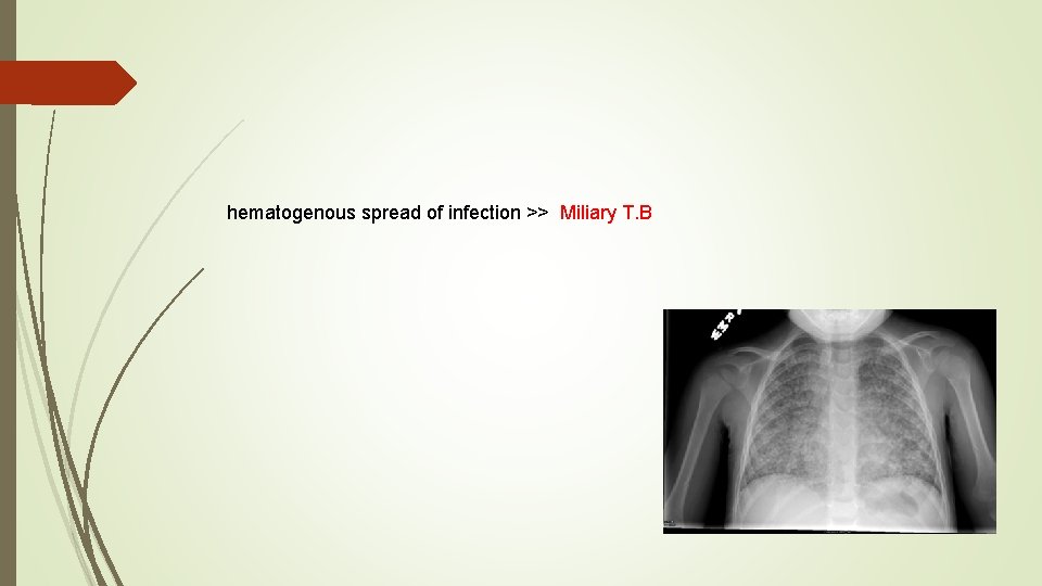 hematogenous spread of infection >> Miliary T. B 