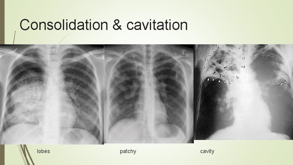 Consolidation & cavitation lobes patchy cavity 