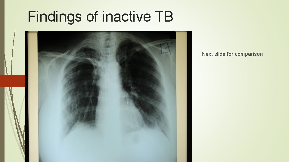 Findings of inactive TB Next slide for comparison 