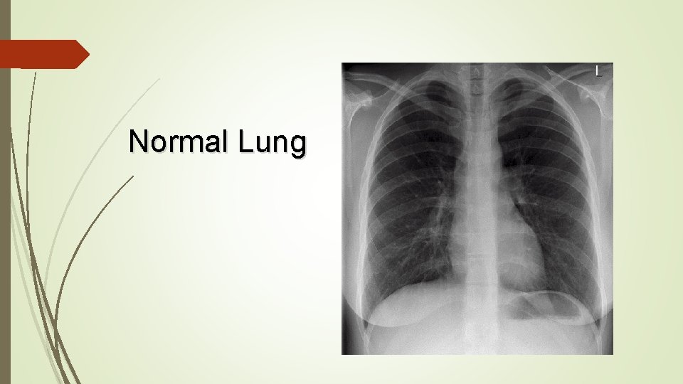 Normal Lung 