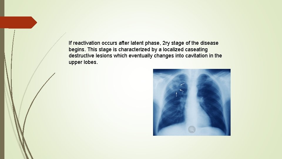 If reactivation occurs after latent phase, 2 ry stage of the disease begins. This
