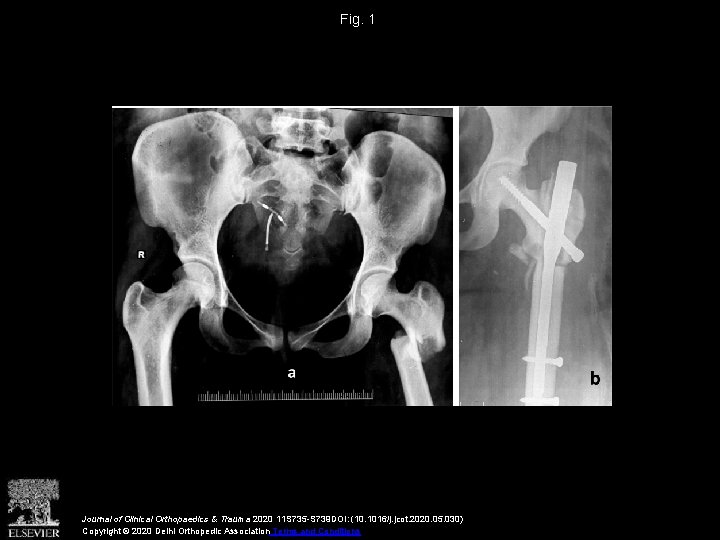 Fig. 1 Journal of Clinical Orthopaedics & Trauma 2020 11 S 735 -S 739