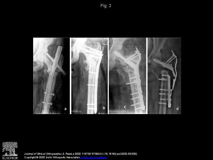 Fig. 2 Journal of Clinical Orthopaedics & Trauma 2020 11 S 735 -S 739