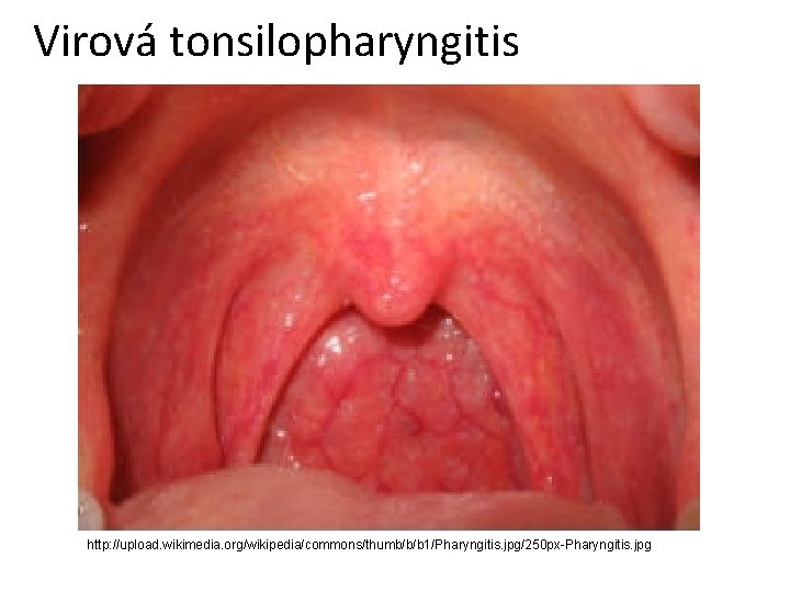 Virová tonsilopharyngitis http: //upload. wikimedia. org/wikipedia/commons/thumb/b/b 1/Pharyngitis. jpg/250 px-Pharyngitis. jpg 